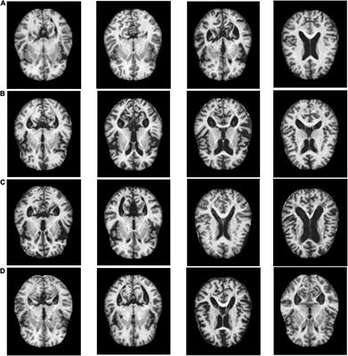 Large Margin and Local Structure Preservation Sparse Representation Classifier for Alzheimer’s Magnetic Resonance Imaging Classification